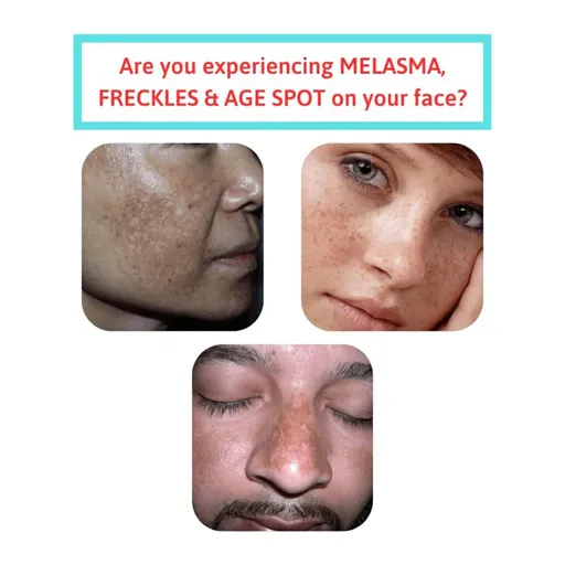 Are you experiencing MELASMA, FRECKLES & AGE SPOT on your face